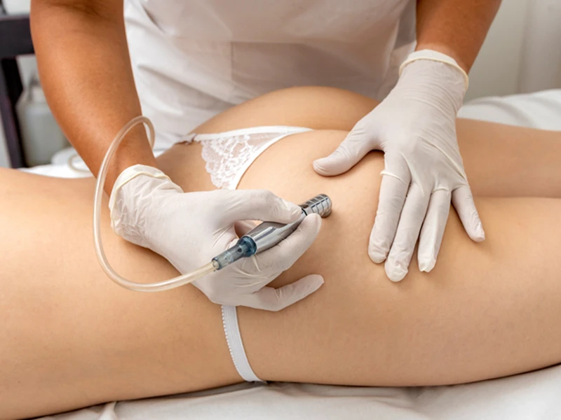 Mesoterapia Corporal