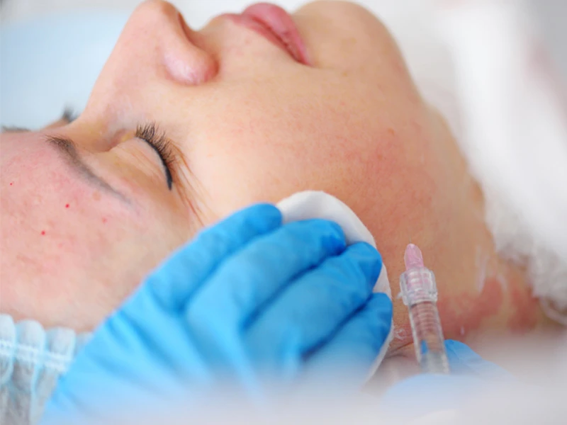 Mesoterapia Facial